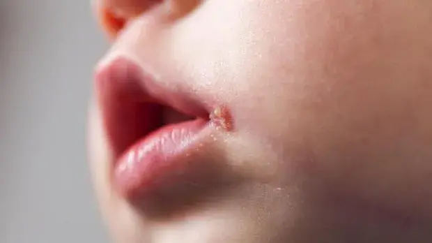 مرض الهربس الجلدي عند الاطفال اعراضه وكيفية علاجه