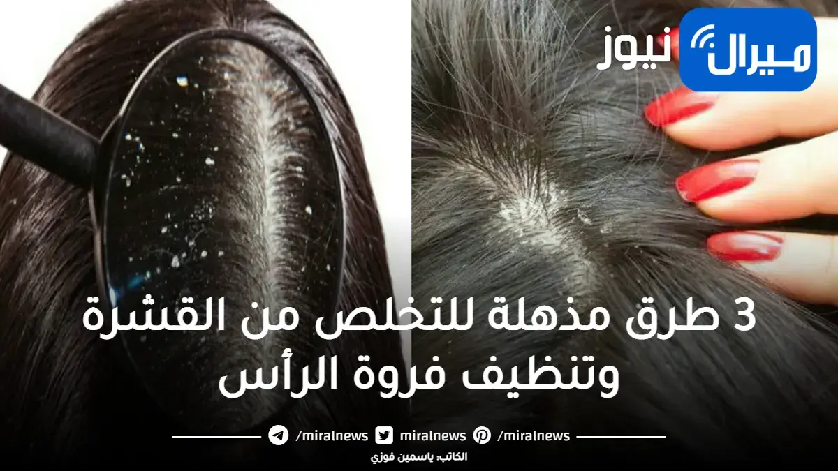 وداعًا قشرة الشعر .. 3 طرق مذهلة للتخلص من القشرة وتنظيف فروة الرأس بشكل نهائي