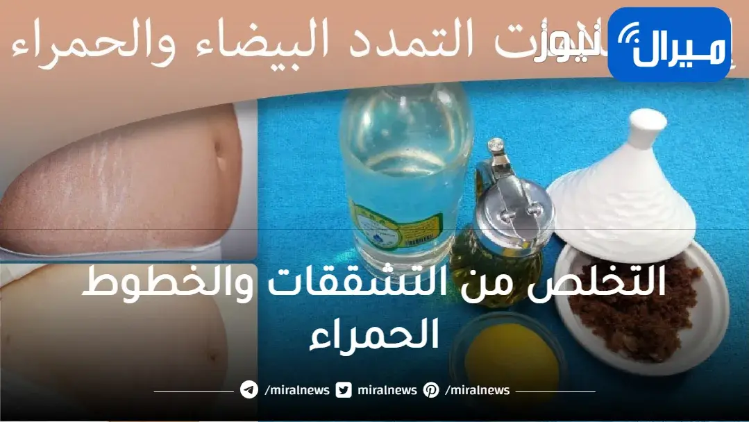 التخلص من التشققات والخطوط الحمراء بالجسم طبيعيًا بدون أي مواد كيميائية