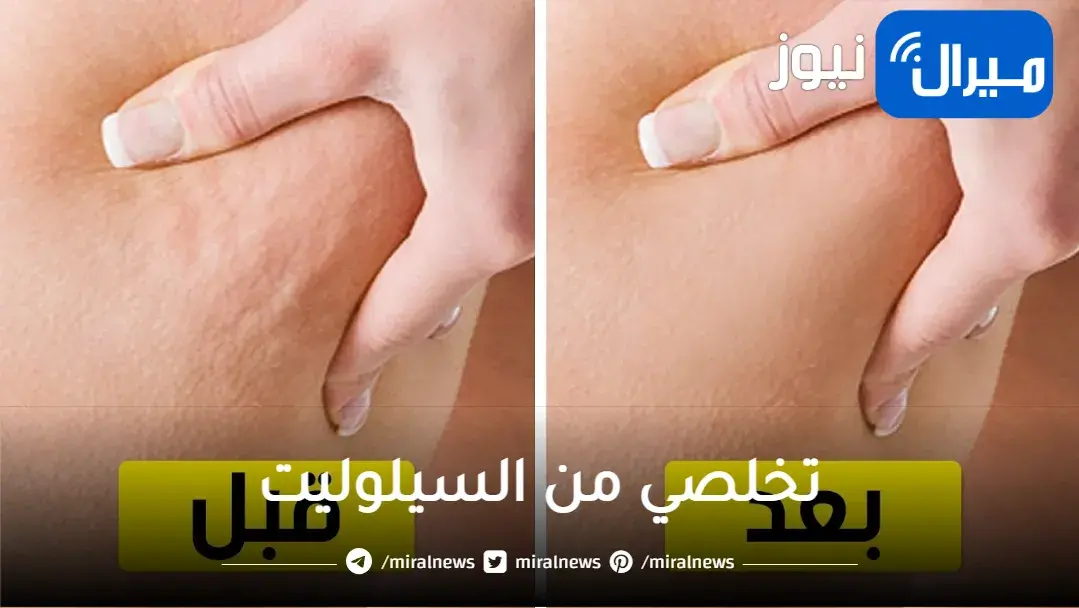 تخلصي من السيلوليت في 4 أشهر فقط بصورة نهائية .. وصفة سحرية