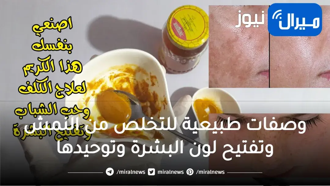 وصفات طبيعية للتخلص من النمش وتفتيح لون البشرة وتوحيدها والقضاء على البقع والكلف من أول مرة