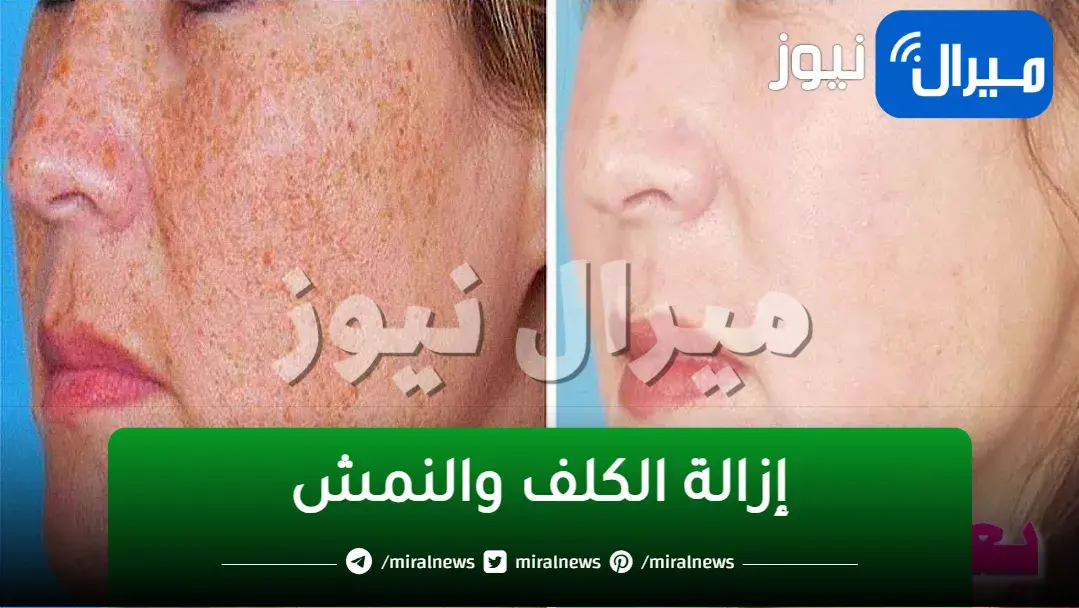 ماسك غير مكلف لتبييض الوجه وعلاج الكف والنمش والبقع الداكنة في البشرة من أول أستخدام