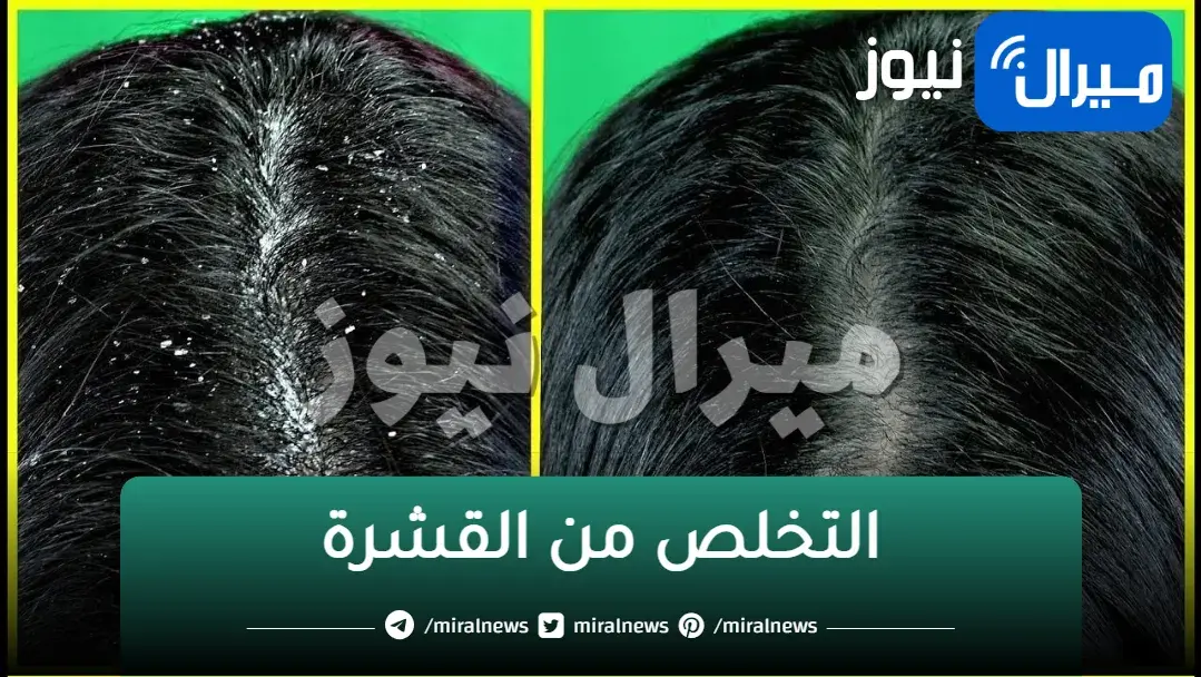 وصفات للتخلص من القشرة من الشعر الدهني لشعر خالي من القشرة