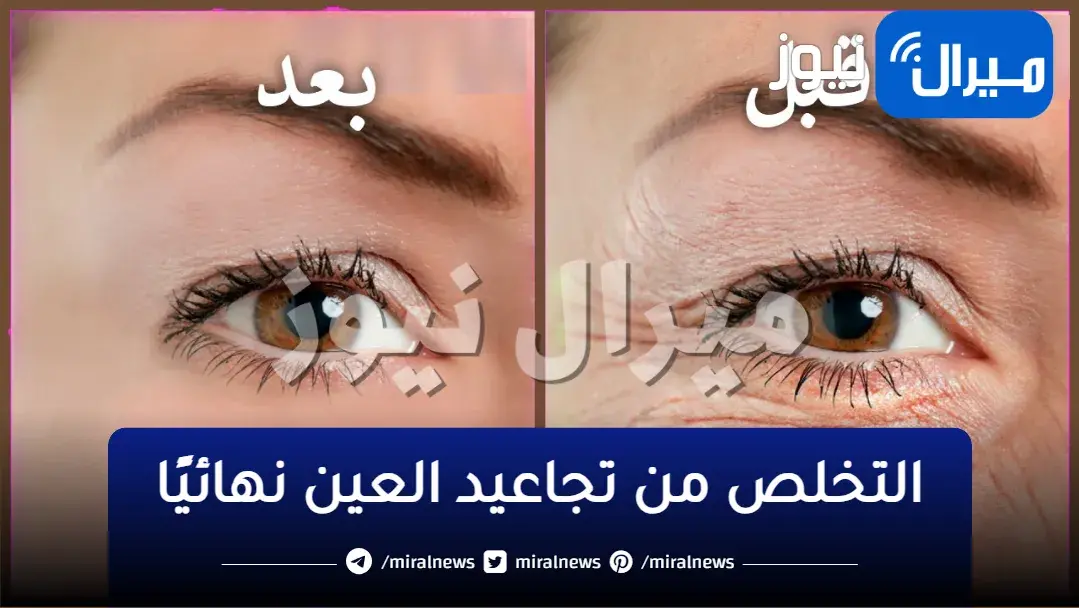 التخلص من تجاعيد العين نهائيًا وإزالة الهالات السوداء حولها طبيعيًا بدون أي مواد كيميائية
