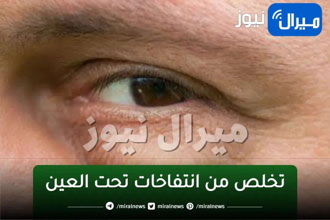 وصفة طبيعية فعالة للتخلص من الانتفاخات تحت العين بمكونات منزلية