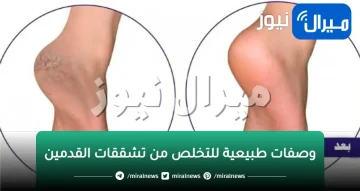 تخلصي من تشققات القدمين بطريقة مدهشة من أول استعمال للوصفة