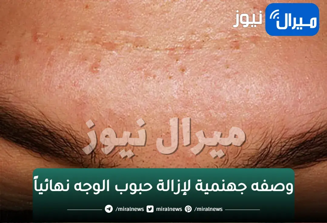 في يوم واحد هتلاحظى الفرق..وصفه جهنمية لإزالة حبوب الوجه نهائياً