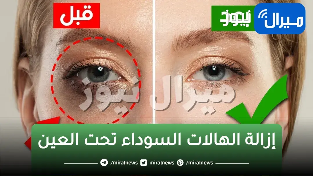 اسرع علاج للهالات السوداء تحت العين منزلياً والنتيجة خيالية