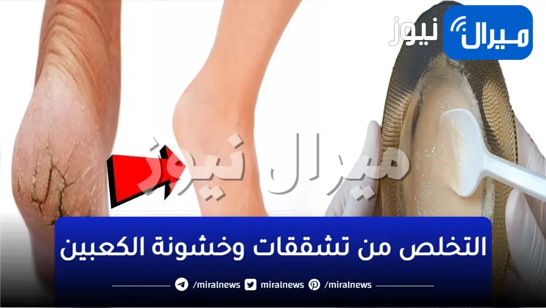 اسرار ملكات الجمال.. ماء الورد والجليسرين معجزة للتخلص من تشققات وخشونة الكعبين فى ثوانى هترجع رجلك زى الاطفال باقوى خلطة جهنمية