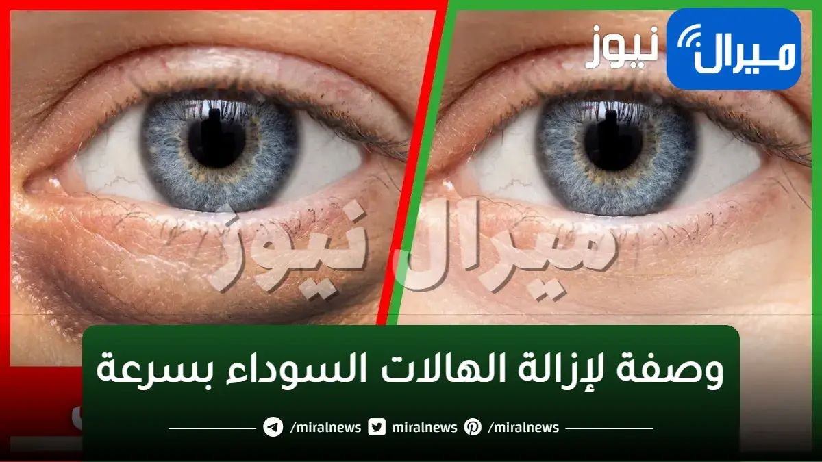 باقوى وصفات طبيعية.. التخلص من الهالات السوداء تحت العين بسرعه البرق
