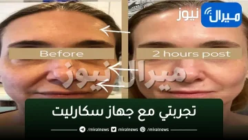تجربتي مع جهاز سكارليت