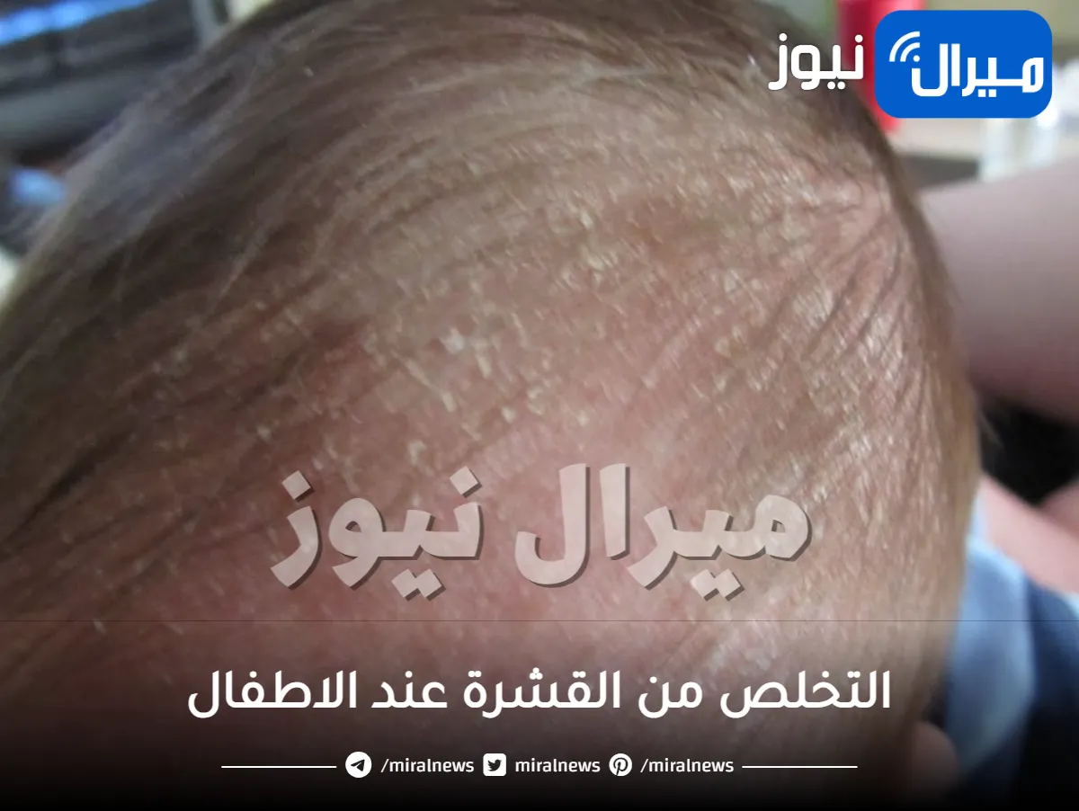 أسهل الطرق للقضاء على قشرة الرأس عند الأطفال