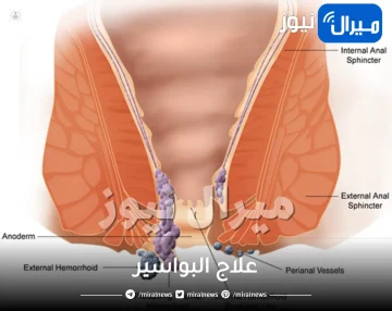 علاج البواسير بطرق بسيطة من المنزل