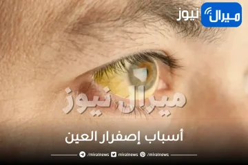 أسباب إصفرار العين للكبار والصغار وطرق علاجه