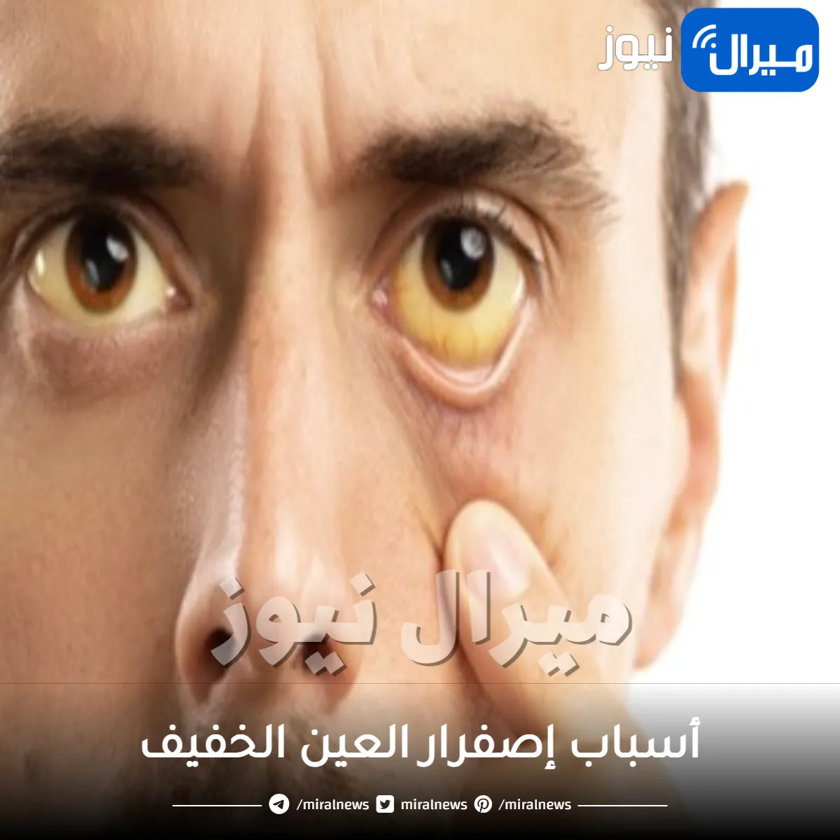 لا تتجاهلها.. أسباب اصفرار العين الخفيف ومتى يكون مؤشراً لحالة صحية تستدعي القلق؟