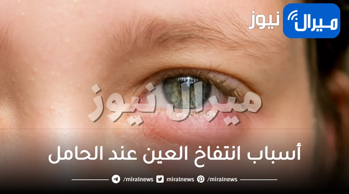 أسباب انتفاخ العين عند الحامل