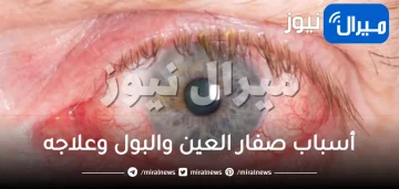 أهم أسباب صفار العين والبول وعلاجه