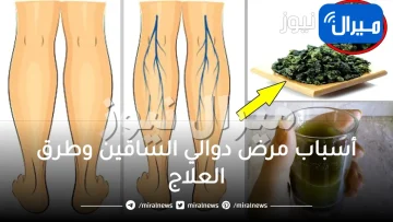أسباب مرض دوالي الساقين وطرق العلاج