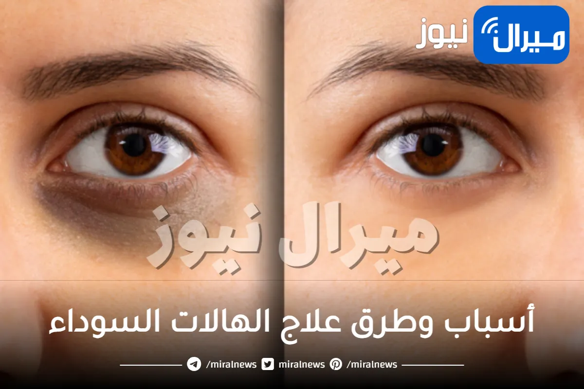 أسباب وطرق علاج الهالات السوداء