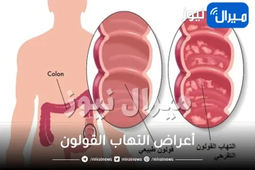 أعراض التهاب القولون من الأسباب والأعراض الى الوقاية والعلاج