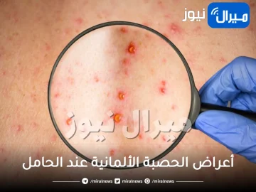 أعراض الحصبة الألمانية عند الحامل