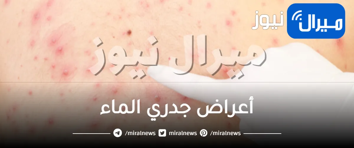 أعراض جدري الماء .. أسباب وأعراض الإصابة بجدري الماء وكيفية علاجه