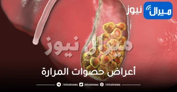 أعراض حصوات المرارة .. أعراض ومضاعفات حصوات وطرق الوقاية منها