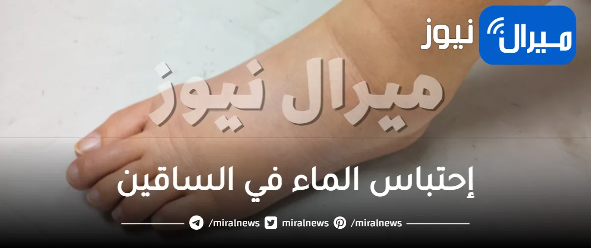 كل ما يخص إحتباس الماء في الساقين