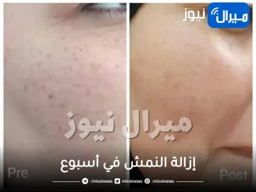 إزالة النمش في أسبوع