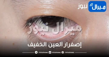 إصفرار العين الخفيف .. تعرفي على الأسباب وطرق العلاج