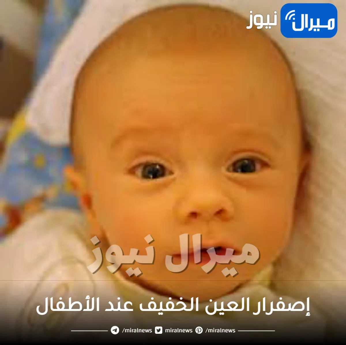 إصفرار العين الخفيف عند الأطفال .. و طرق علاج الإصفرار