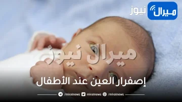 إصفرار العين عند الأطفال .. ما هي الاسباب وطرق العلاج