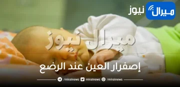 إصفرار العين عند الرضع .. ما الأسباب وطرق العلاج ؟