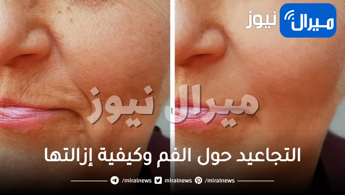 التجاعيد حول الفم وكيفية إزالتها