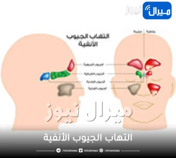 التهاب الجيوب الأنفية .. الاعراض وطرق العلاج
