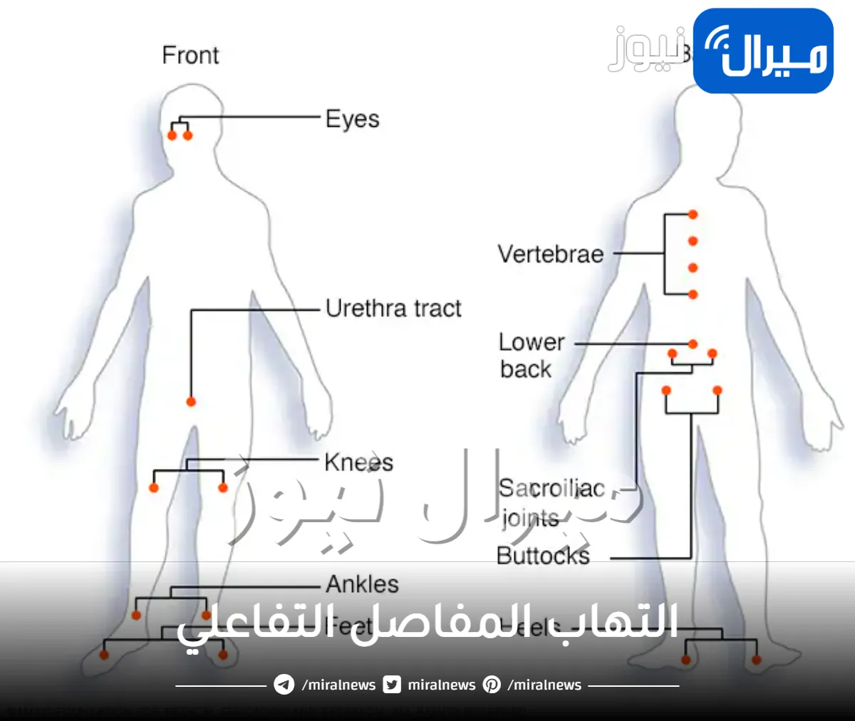 التهاب المفاصل التفاعلي .. تفاصيل أعراض وعلاج التهاب المفاصل التفاعلي
