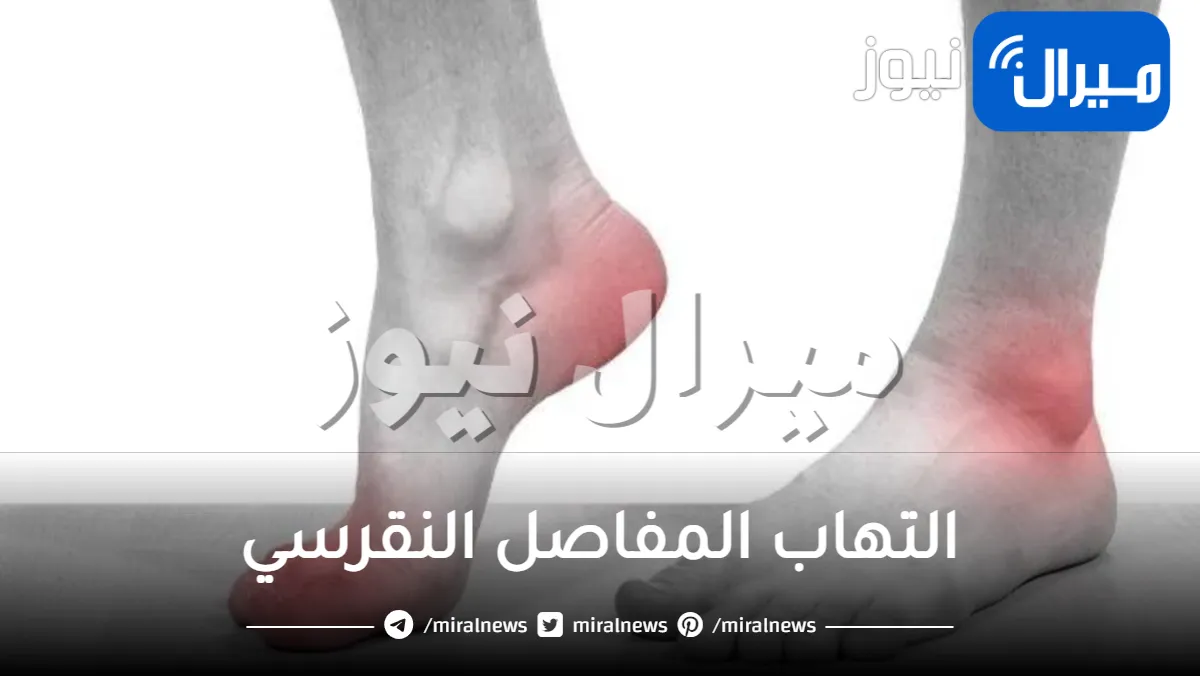 التهاب المفاصل النقرسي .. أسباب الإصابة بالتهاب المفاصل النقرسي وعلاجه