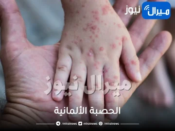 الحصبة الألمانية .. الأسباب والأعراض وطرق الوقاية الممكنة