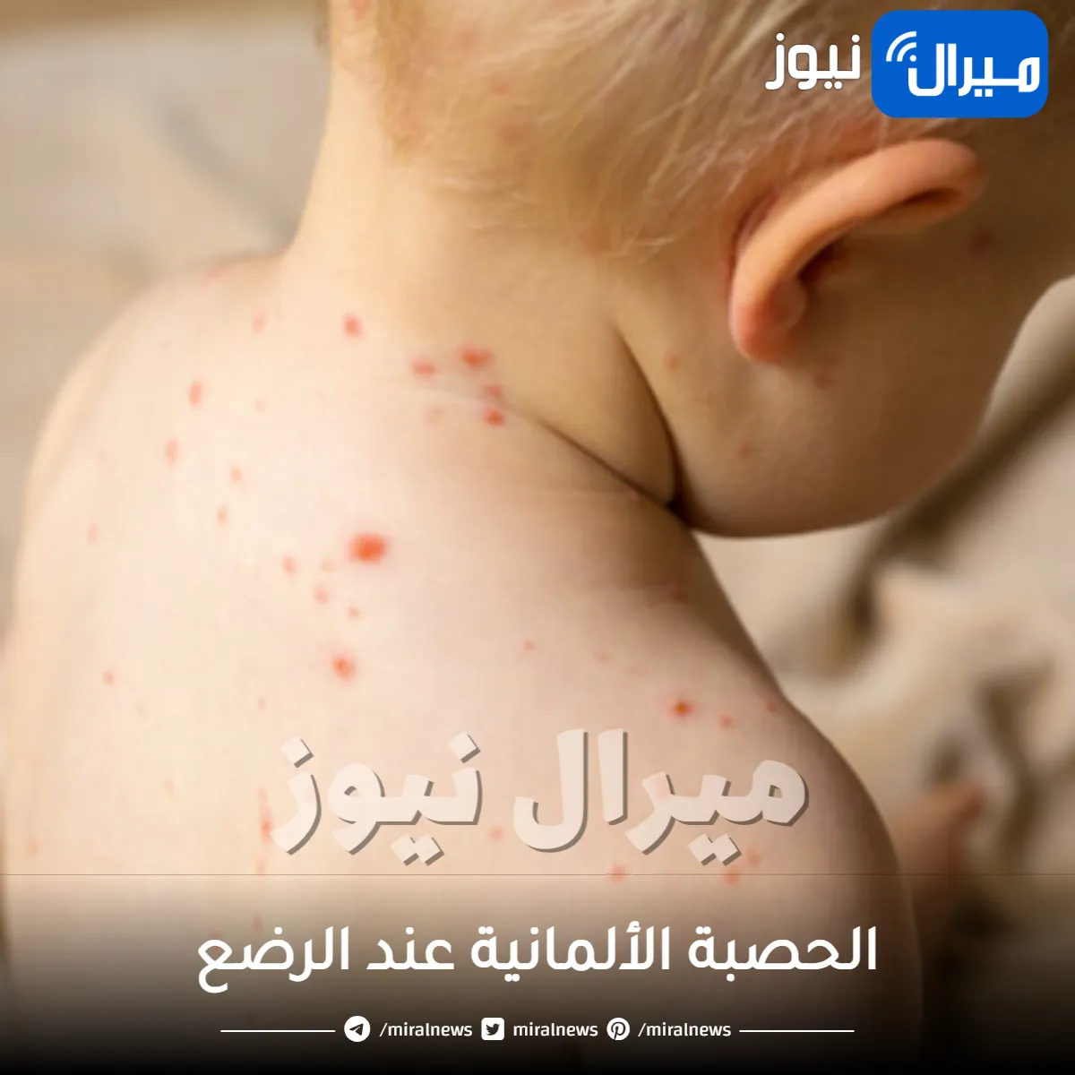 الحصبة الألمانية عند الرضع .. تعرفي على اعراضها والتطعيمات للوقاية منها