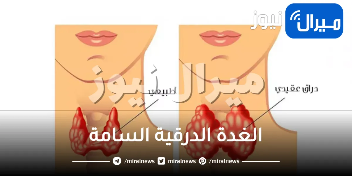 الغدة الدرقية السامة .. أسبابها وأعراضها