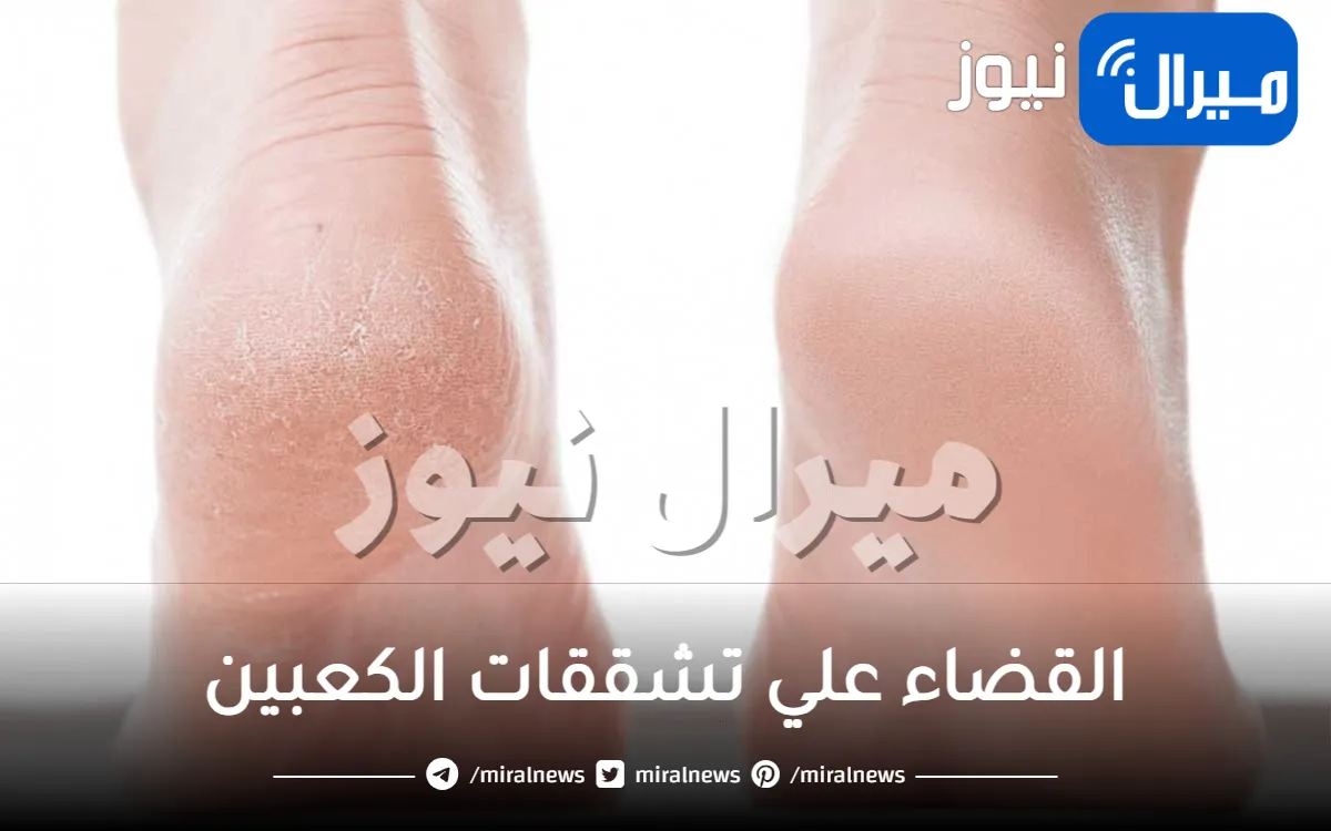 وصفة طبيعية هندية تقضي على تشققات الكعبين