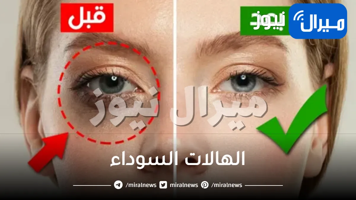 التخلص من الهالات السوداء بالمواد الطبيعية