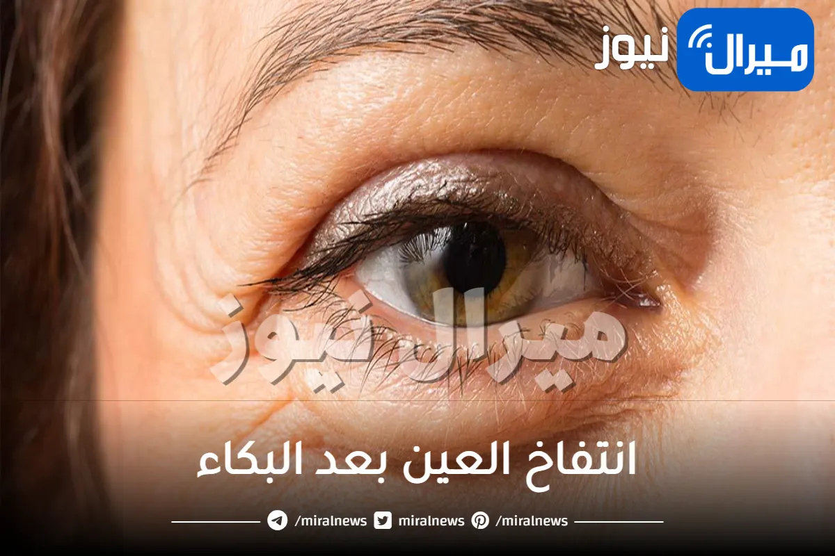 انتفاخ العين بعد البكاء .. ما اهم أسبابه وطرق العلاج