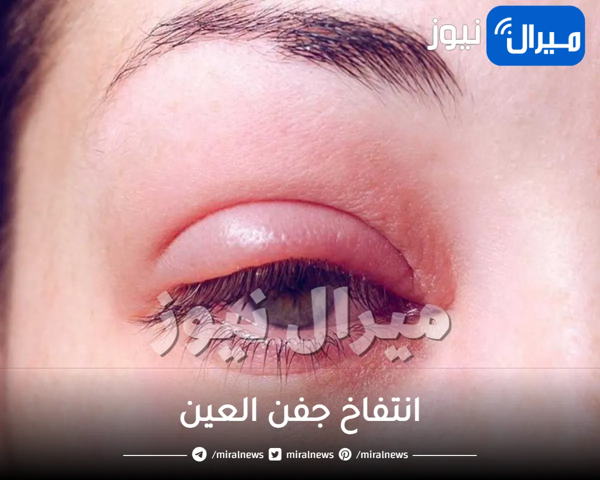 انتفاخ جفن العين .. أبرز الأعراض والأسباب وكيفية علاجه بسهولة