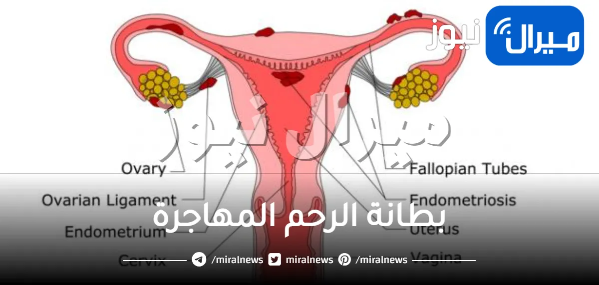 بطانة الرحم المهاجرة .. ماهي وما أعراضها وأسبابها وكيفية العلاج منها؟