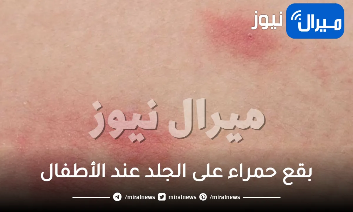 بقع حمراء على الجلد عند الأطفال .. أسبابها وعلاجها