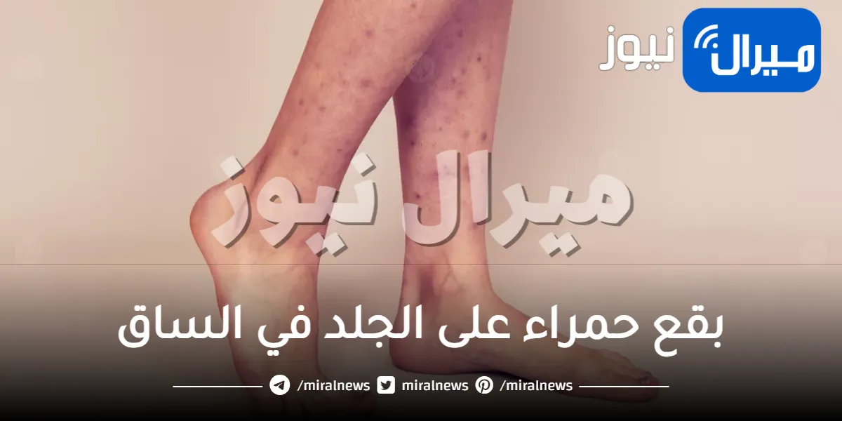 بقع حمراء على الجلد في الساق .. طرق العلاج والوقاية منها