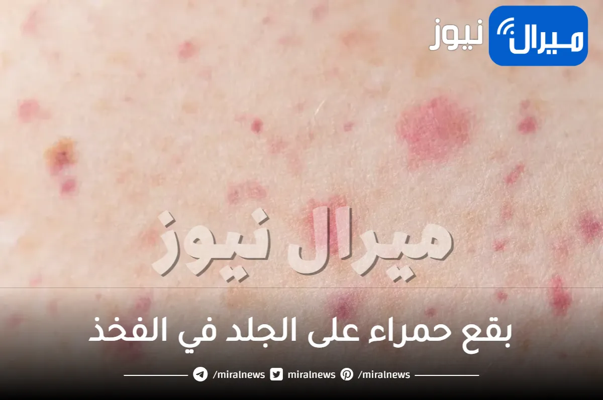 سبب ظهور بقع حمراء على الجلد في الفخذ