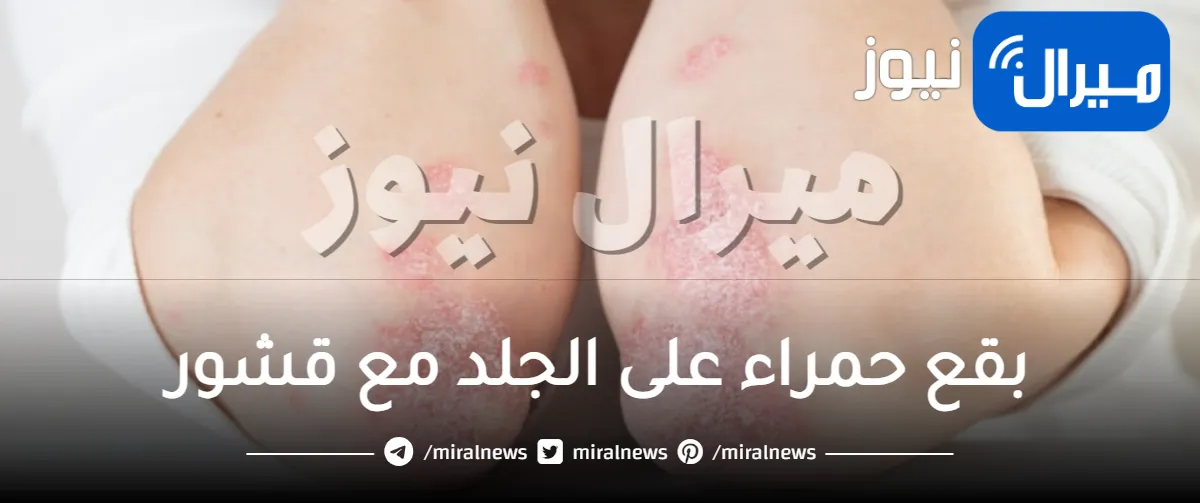 بقع حمراء على الجلد مع قشور ..  طرق علاج البقع الحمراء