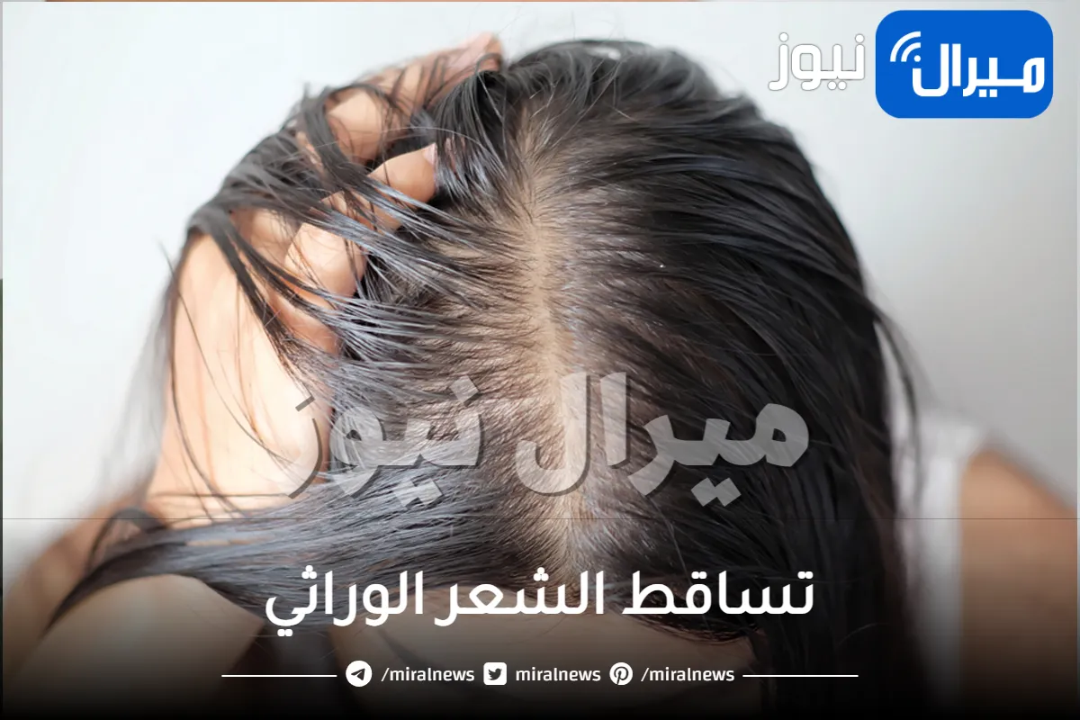 تعرفي على طرق علاج تساقط الشعر الوراثي عند النساء